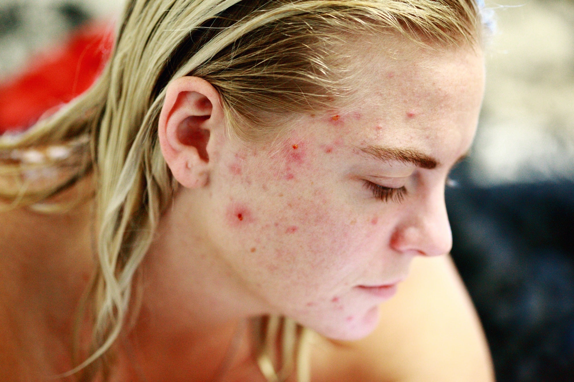 Know Your Enemy: Understanding Acne and How to Treat It