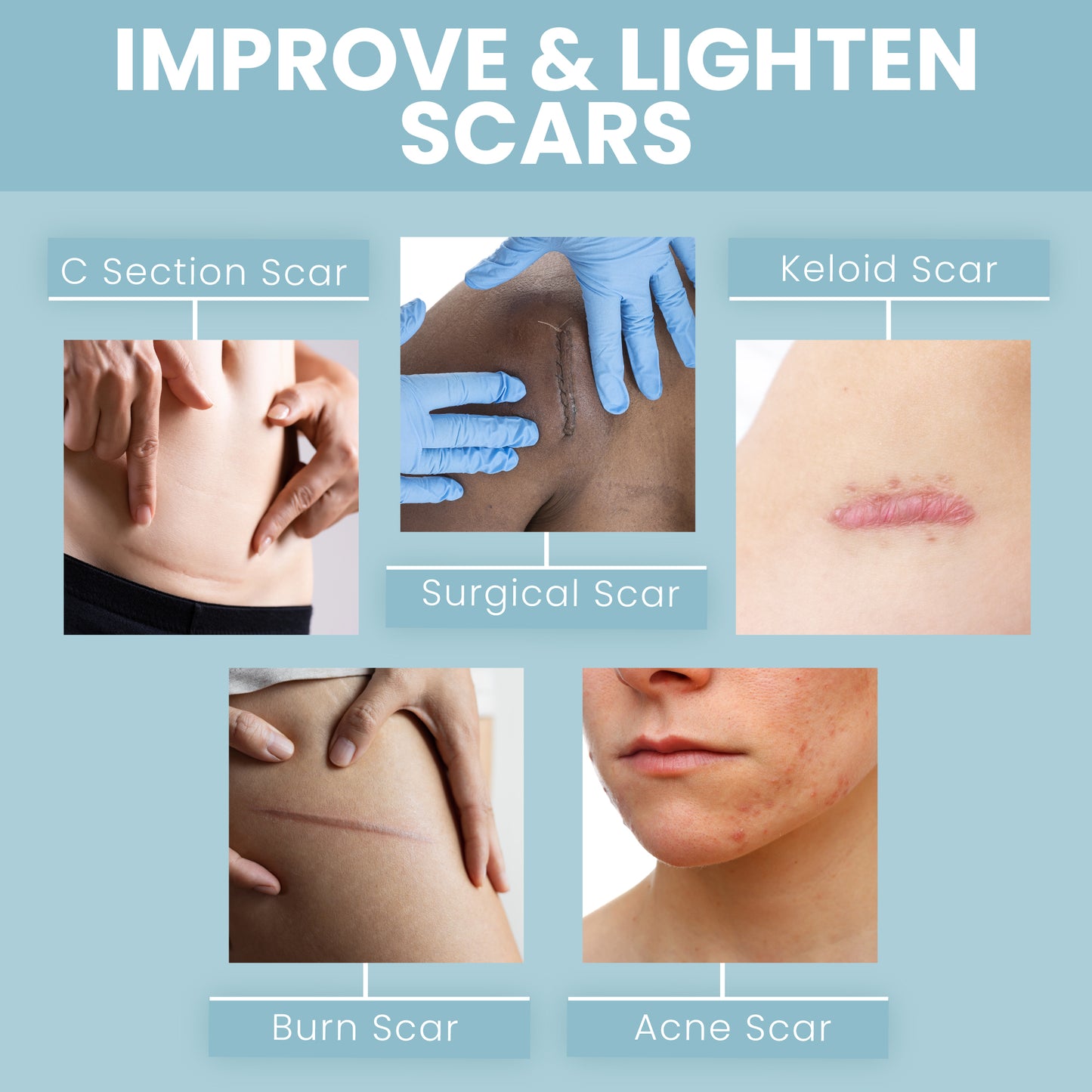 Scar Tape